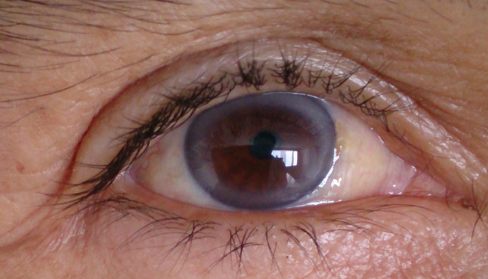 ما هي أعراض ارتفاع الكوليسترول في الجسم؟